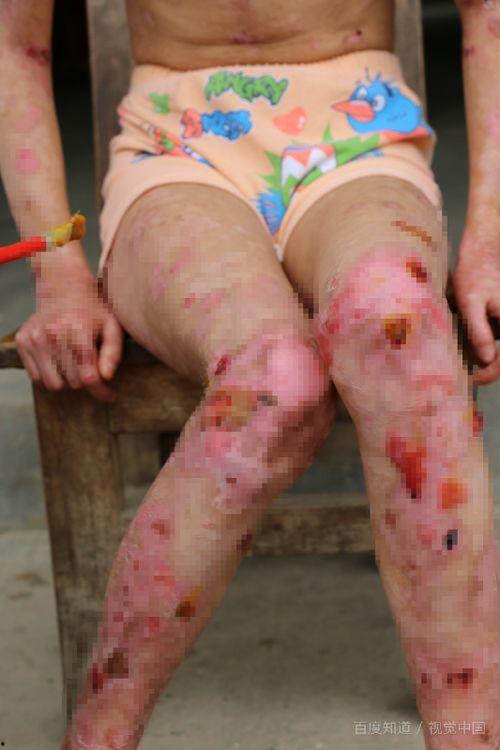 在线拍照识别皮肤病,在线拍照识别技术革新